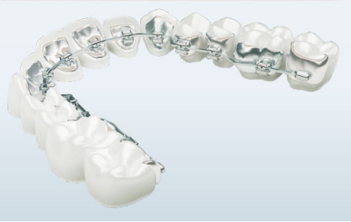 リンガルブラケット