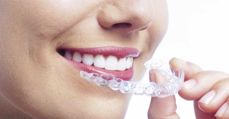 インビザライン