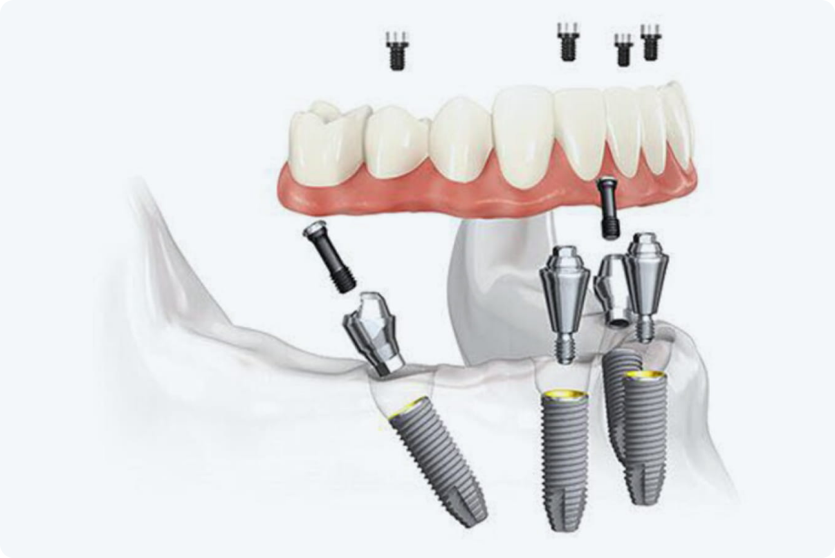 オールオン4とは