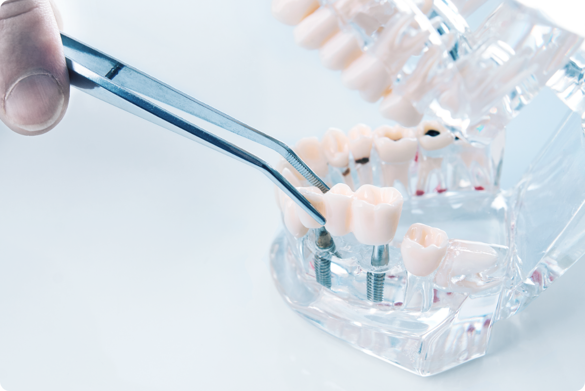 インプラント治療は、今では一般的な歯科治療の選択肢の一つです。