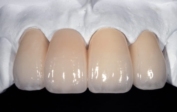 ジルコニアボンド