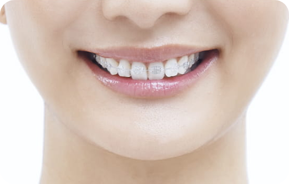 クリアブラケット矯正