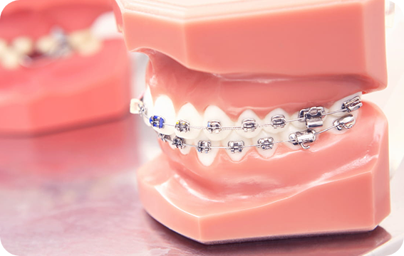   ブラケット矯正（ワイヤー矯正）